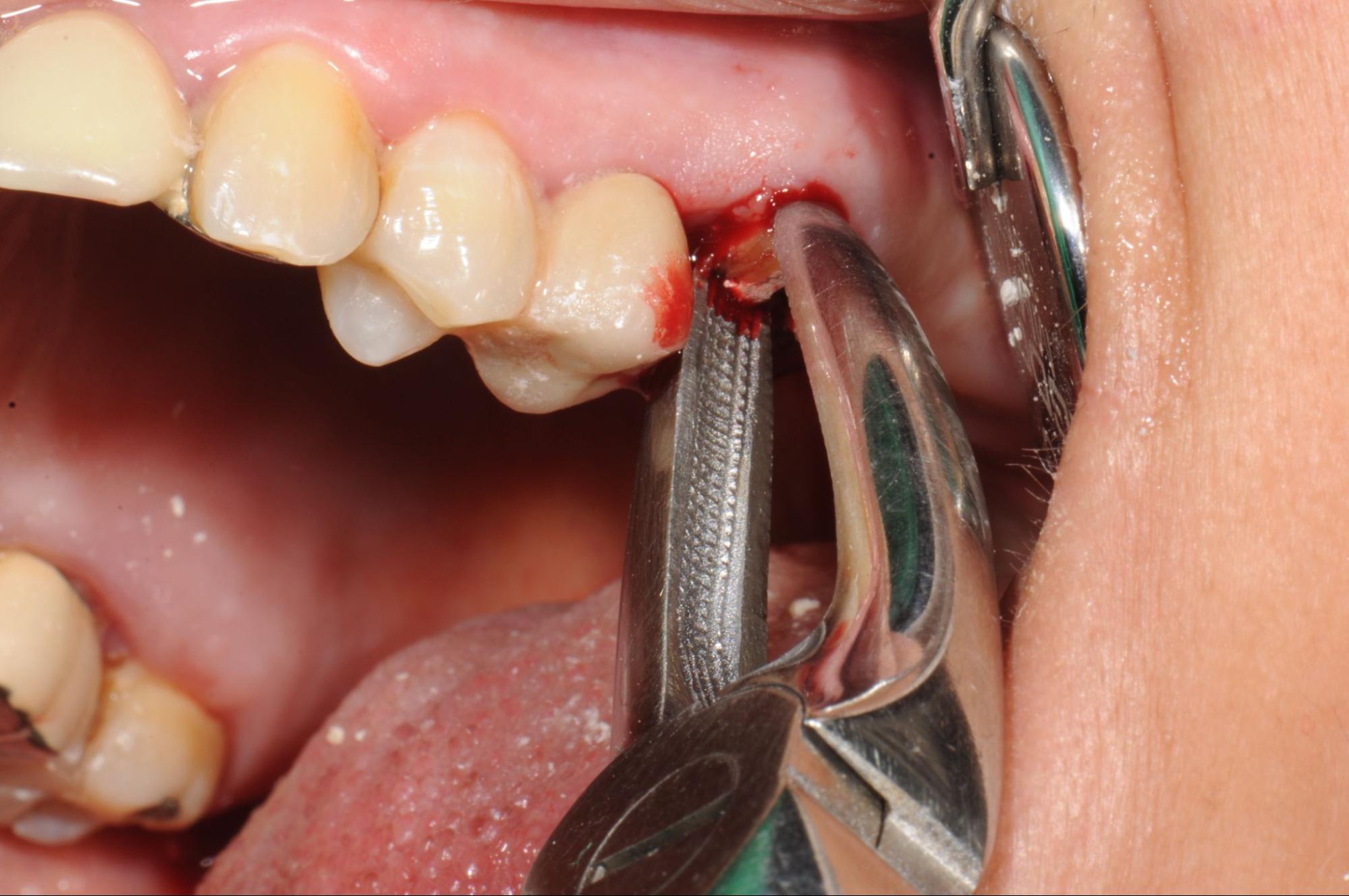 Extraction & Surgical Extraction