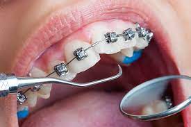 Fixed orthodontic appliances (braces)