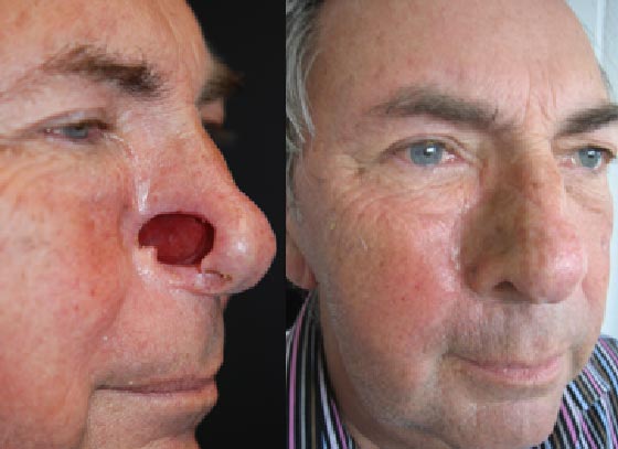 Maxillofacial prosthetics (for facial defects)