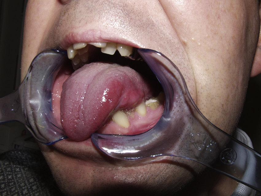 Oral cancer & reconstruction