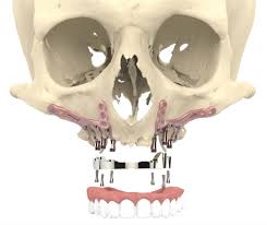 Patient specific implant