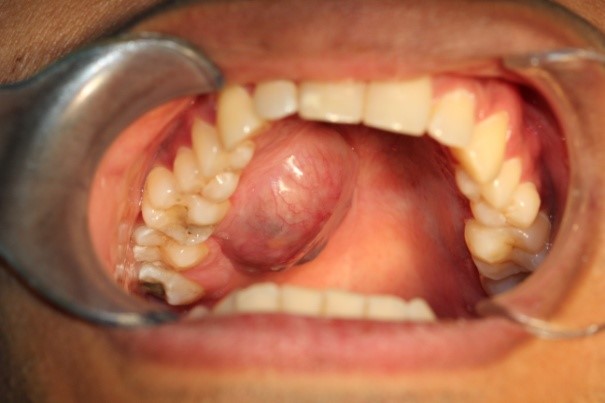 Removal of Oral Tumors and Cysts