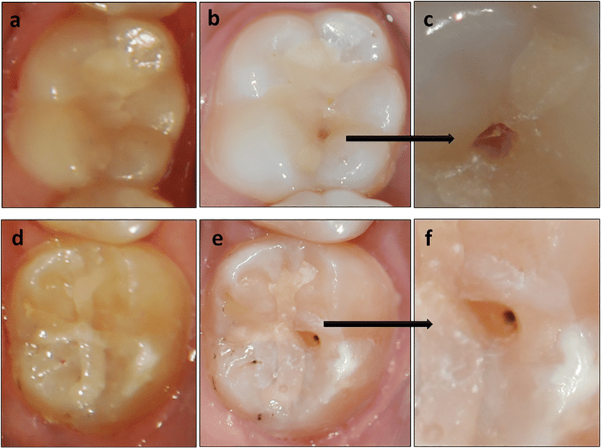 Restorations (composite, GIC)