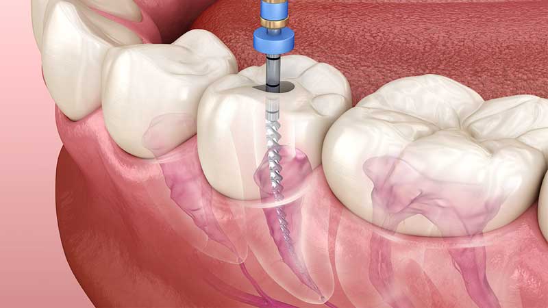 Root canal treatment (RCT)