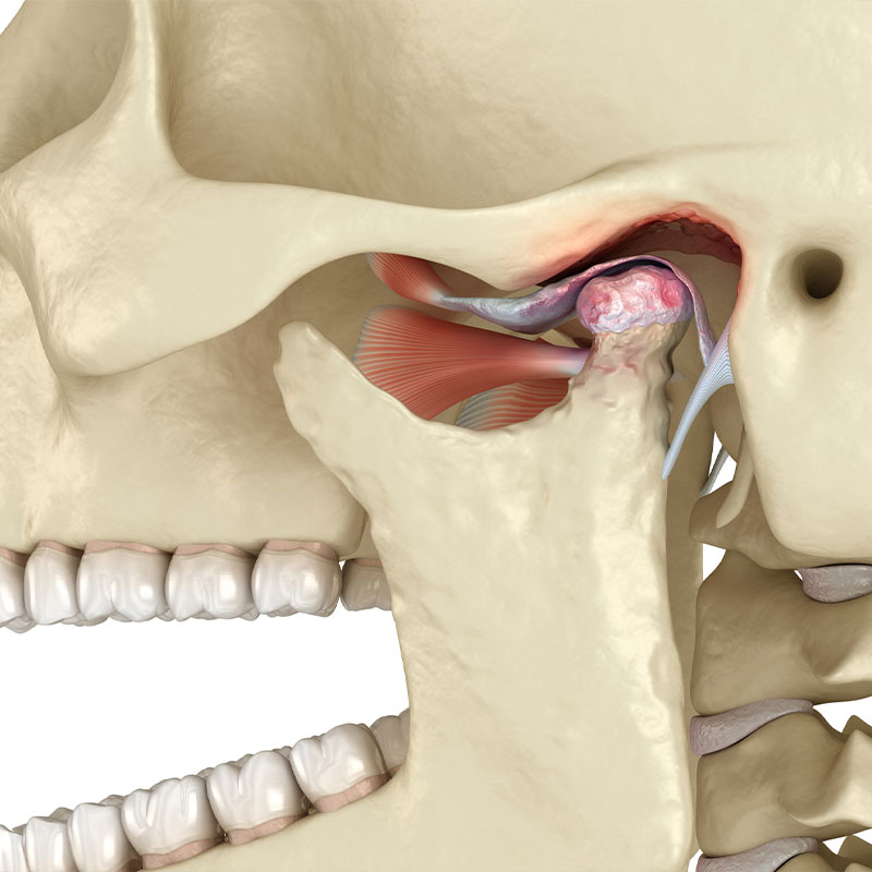TMJ Disorders (Temporomandibular Joint Issues)