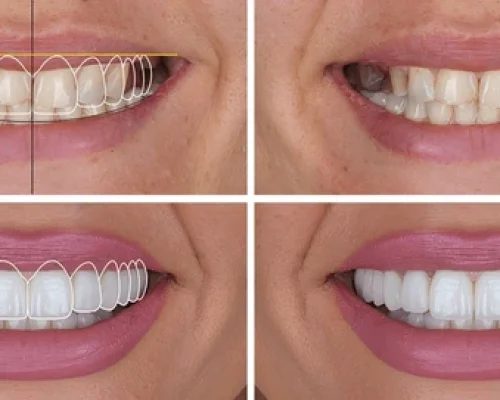 Aesthetic restorations and smile Design