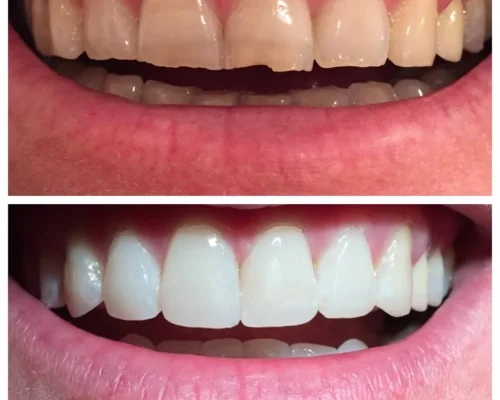 Cosmetic recontouring