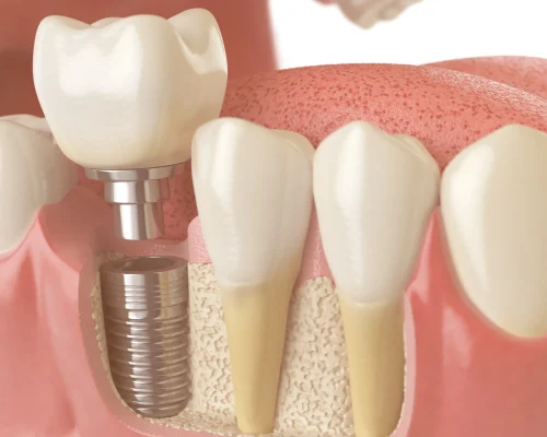 Dental Implants and Bone Grafting