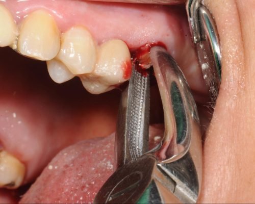 Extraction & Surgical Extraction