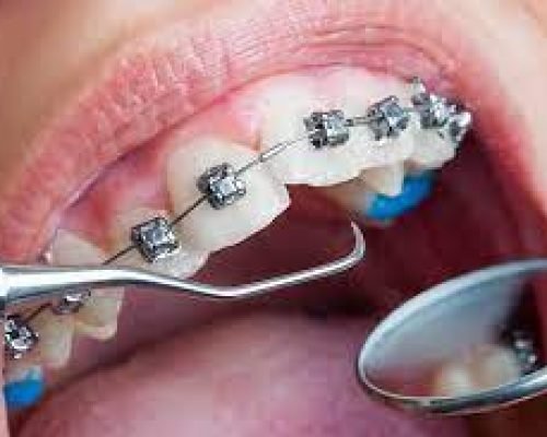 Fixed orthodontic appliances (braces)