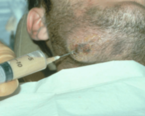 Management of facial Infections