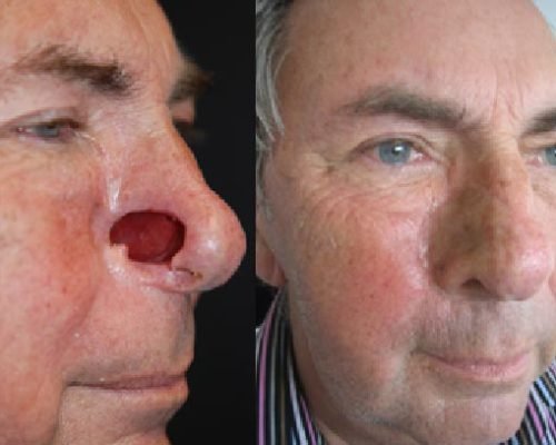 Maxillofacial prosthetics (for facial defects)