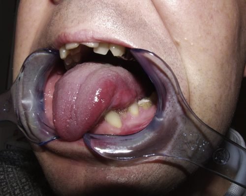 Oral cancer & reconstruction