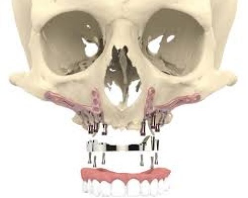 Patient specific implant