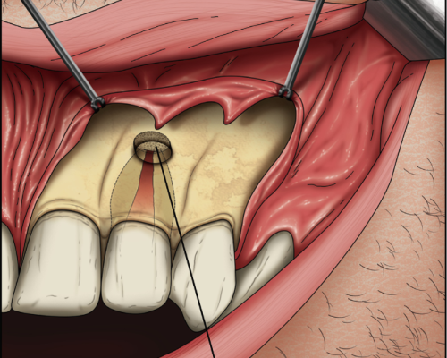 Periapical surgeries (apicoectomy, curettage)