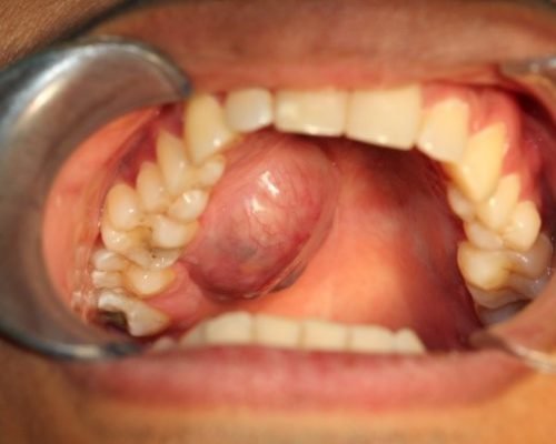 Removal of Oral Tumors and Cysts