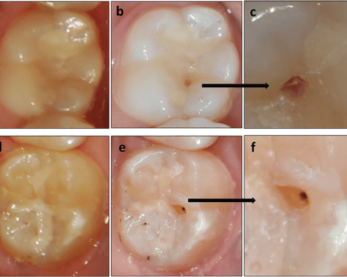 Restorations (composite, GIC)