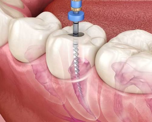 Root canal treatment (RCT)