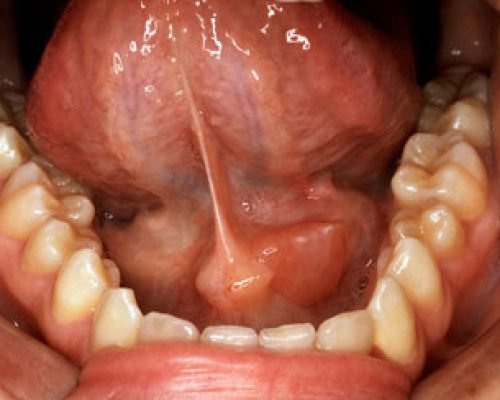 Salivary Gland Disorders