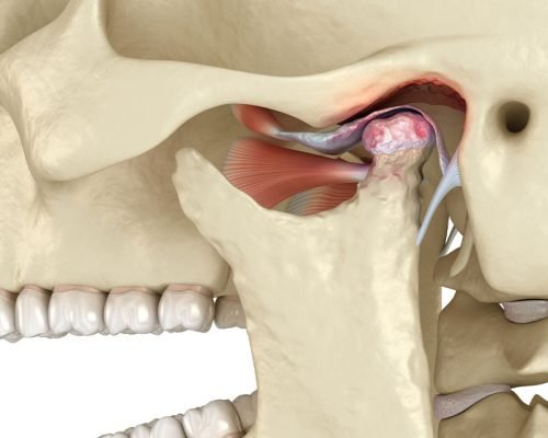 TMJ Disorders (Temporomandibular Joint Issues)