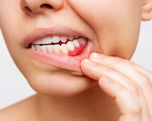 Treatment Based on Oral Pathology