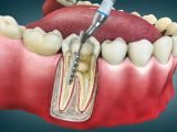 root canal